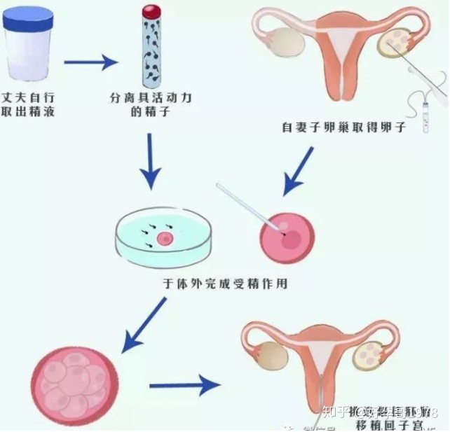 供卵试管婴儿后如何预防宫外孕