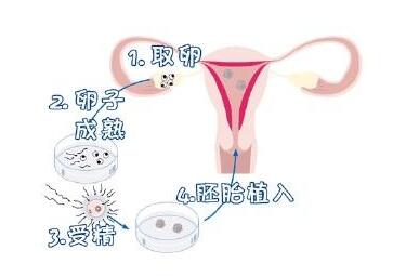 广东河源做供卵试管婴儿优惠政策